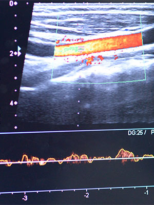 Blood flow Assessment